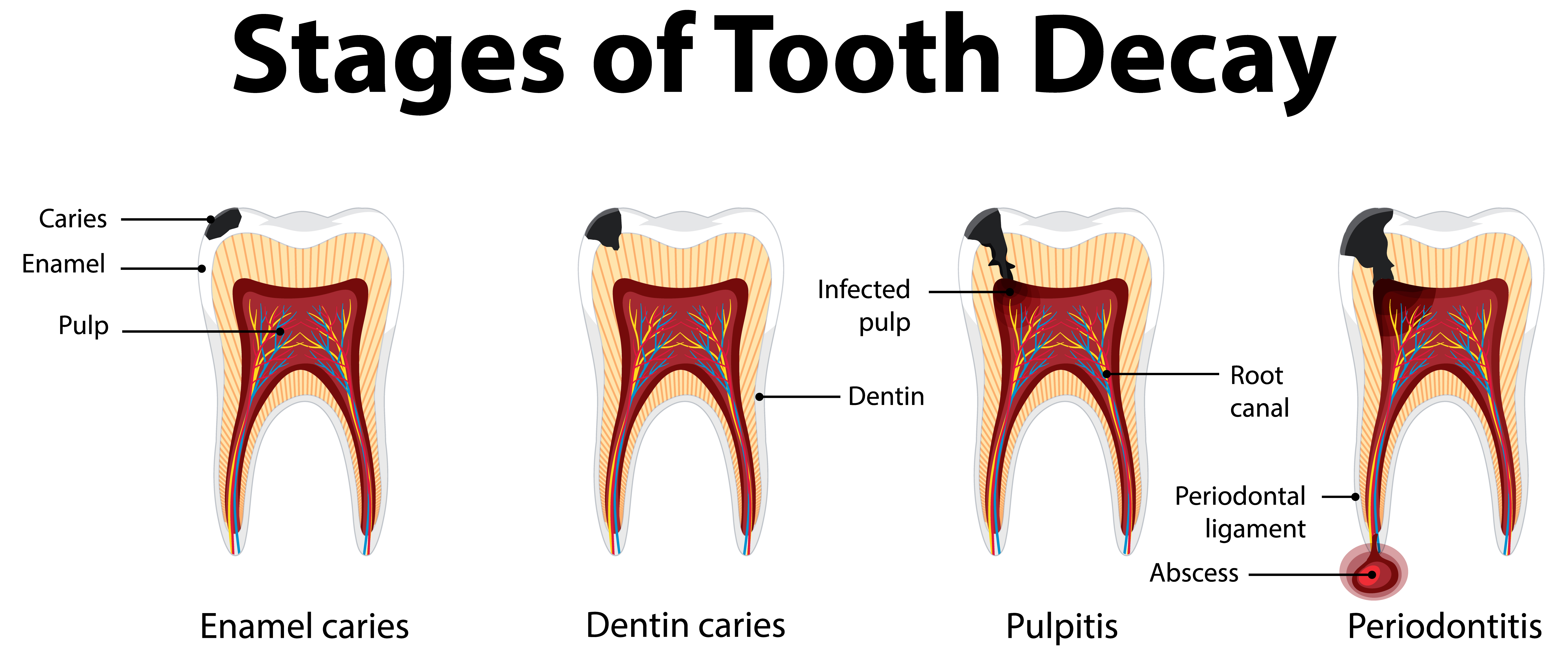 Endodonciai eszközök gyökércsatorna-kezeléshez