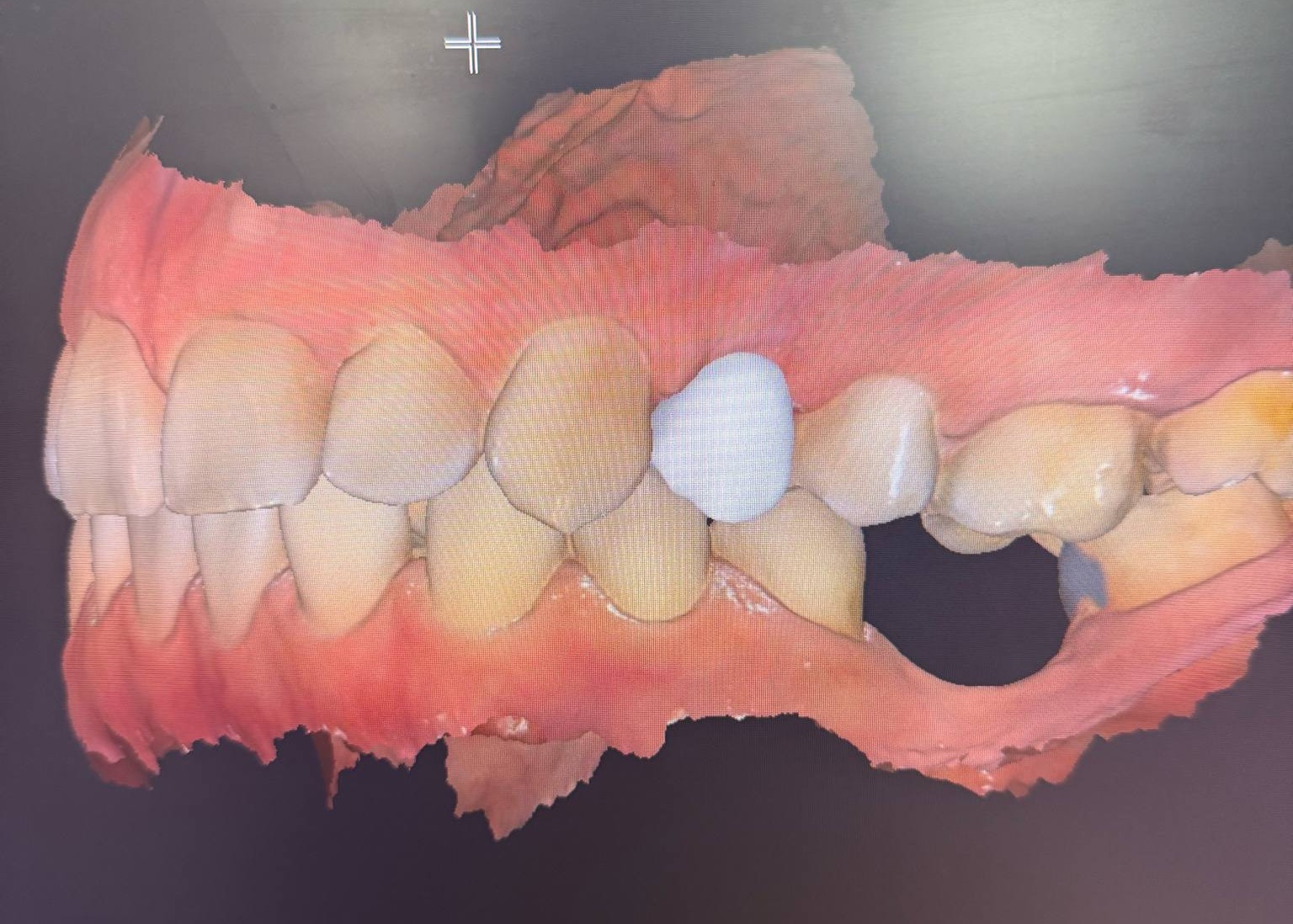 Implantológiai tervezés előtte