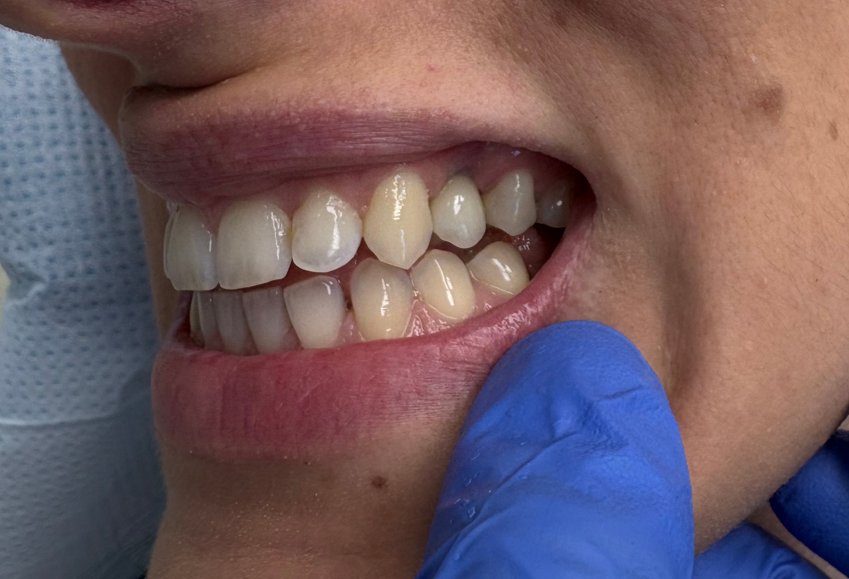 Implantológiai rehabilitáció utána