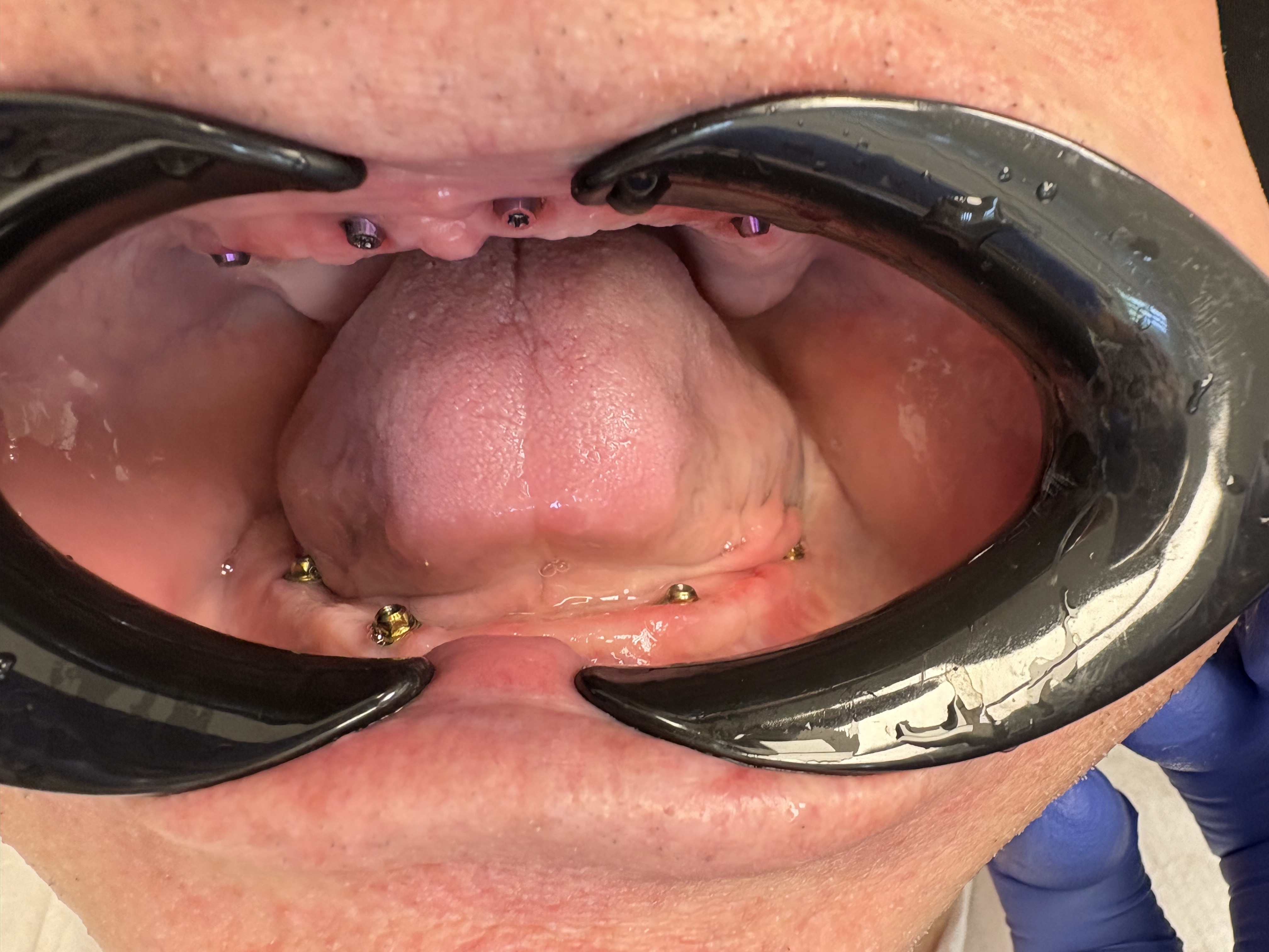 Implantátumokon rögzített híd előtte