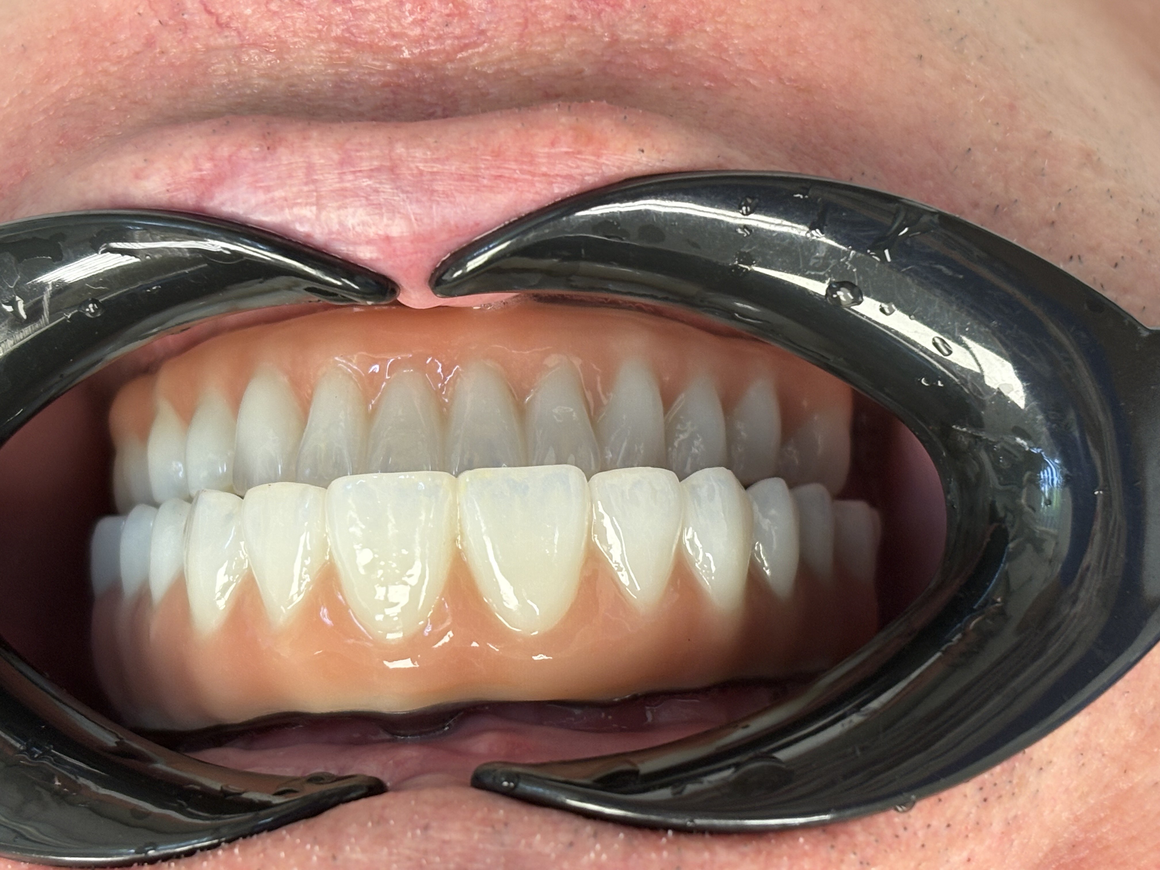 Implantátumokon rögzített híd utána